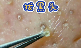 黑头视频,揭秘黑头成因及有效去除方法